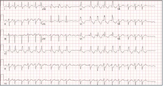 ECG of a recent syncope event 2