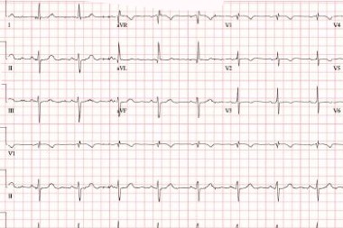 An 81-Year-Old Female with a History of A-Fib and a Recent Syncope Event
