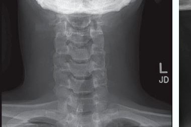 A 30-Year-Old with a Painful Neck ‘Bump’ and Difficulty Swallowing