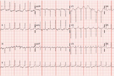 A 46-Year-Old Male Who Presents Due to His Defibrillator Firing