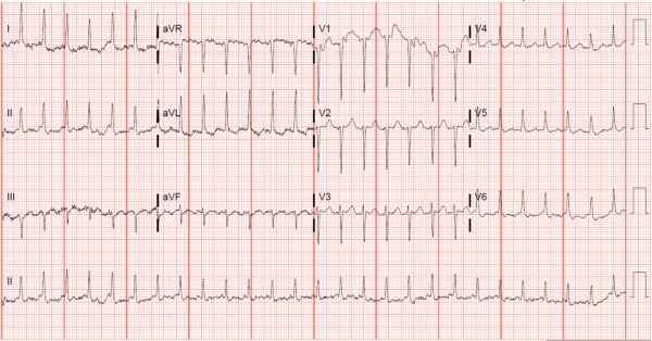 46-year-old's defibrillator firing