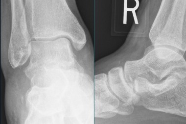A 31-Year-Old with Pain After Twisting His Ankle