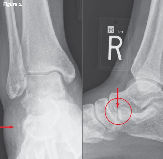 31-Year-Old with a Twisted Ankle X-ray Resolution