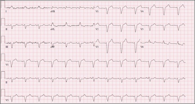 77-Year-Old Man Presents with Dyspnea