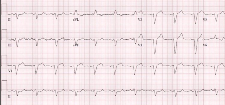 A 77-Year-Old Man Presents with Dyspnea