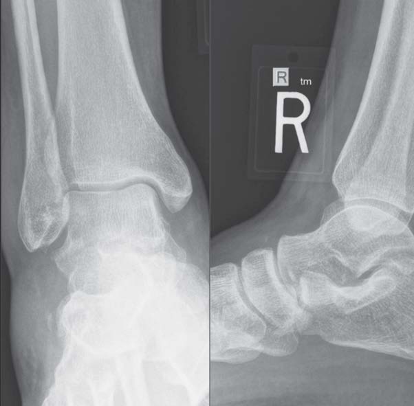 31-year-old with Twisted Ankle X-ray