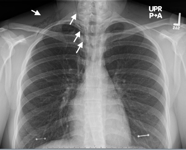 20-Year-Old Female with Chest Pain and Shortness of Breath, pneumomediastinum while smoking Marijuana Feature 1