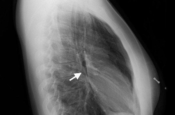 20-Year-Old Female with Chest Pain and Shortness of Breath, pneumomediastinum while smoking Marijuana Figure 2