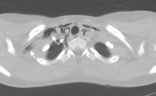 20-Year-Old Female with Chest Pain and Shortness of Breath, pneumomediastinum while smoking Marijuana Figure 3