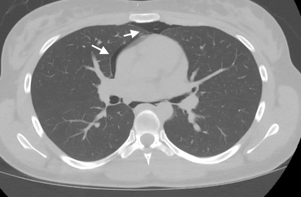 20-Year-Old Female with Chest Pain and Shortness of Breath, pneumomediastinum while smoking Marijuana Figure 4