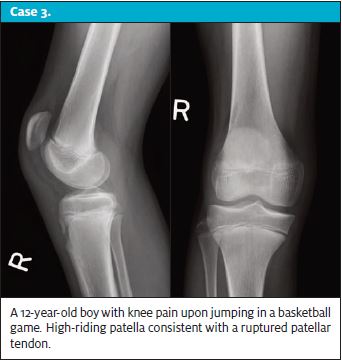When X-Rays Lie - Case 3 Image of rupture patella tendon