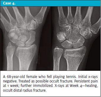 When x-rays lie - Case 4 of a healing occult distal radius fracture