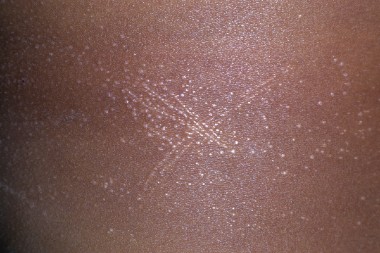 A 6-Year-Old Girl with Papules on Her Abdomen