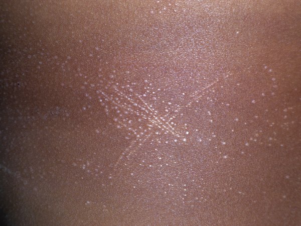 Papules on Her Abdomen image