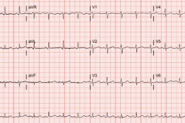 A 57-Year-Old Female with Shortness of Breath and Weeks of Chest Pain
