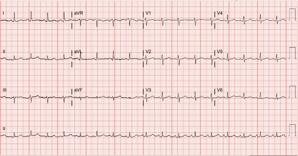 Weeks of Chest Pain ECG