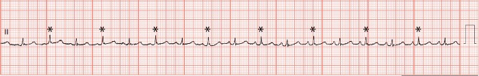 Weeks of Chest Pain ECG Analysis