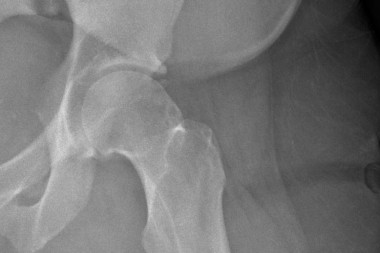 A 36-Year-Old Male with Chronic, Worsening Hip Pain