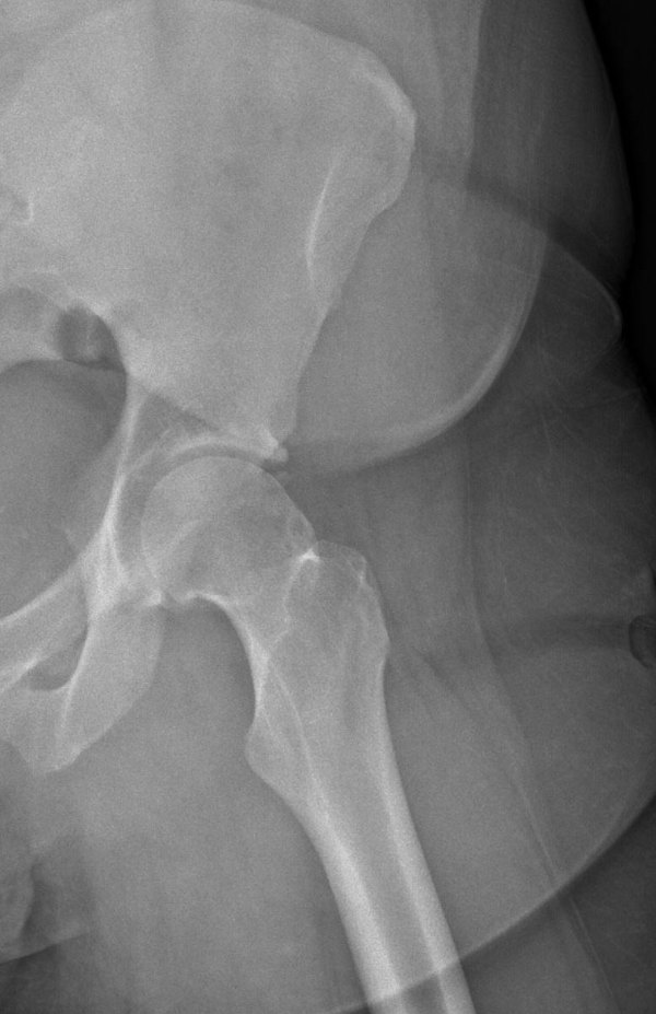 Images Challenge, Chronic worsening hip pain x-ray image