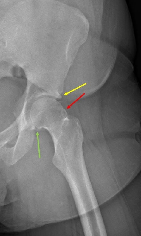 Chronic worsening hip pain x-ray image