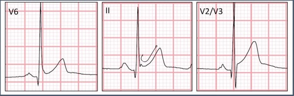 ST elevation