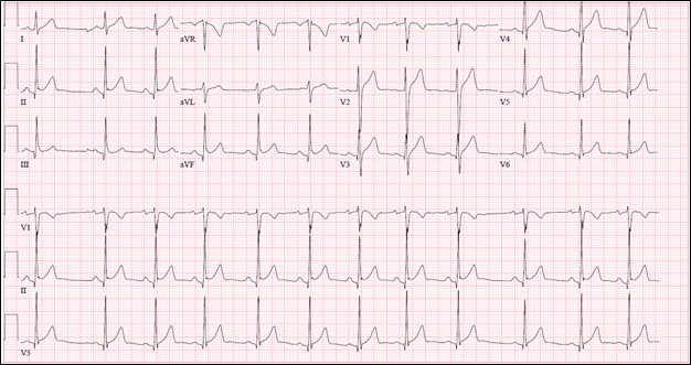 ST elevation ECG