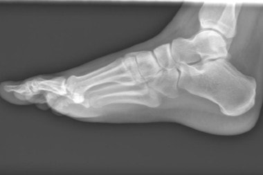 A Young Man with Acute Ankle Injury