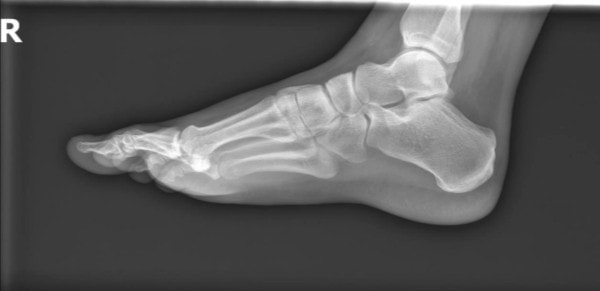 Man with Acute Ankle Injury XR