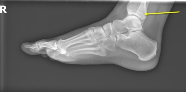 Man with Acute Ankle Injury XR Resolution