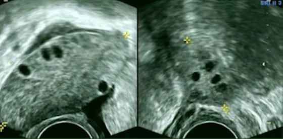 Figure 1, Ovary Ultrasound of Ovarian Torsion