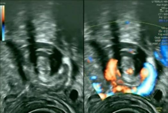 Figure 2. Ovarian Torsion, Twisted Fallopian Tube