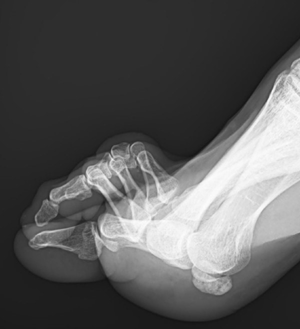 Claw Foot X-Ray
