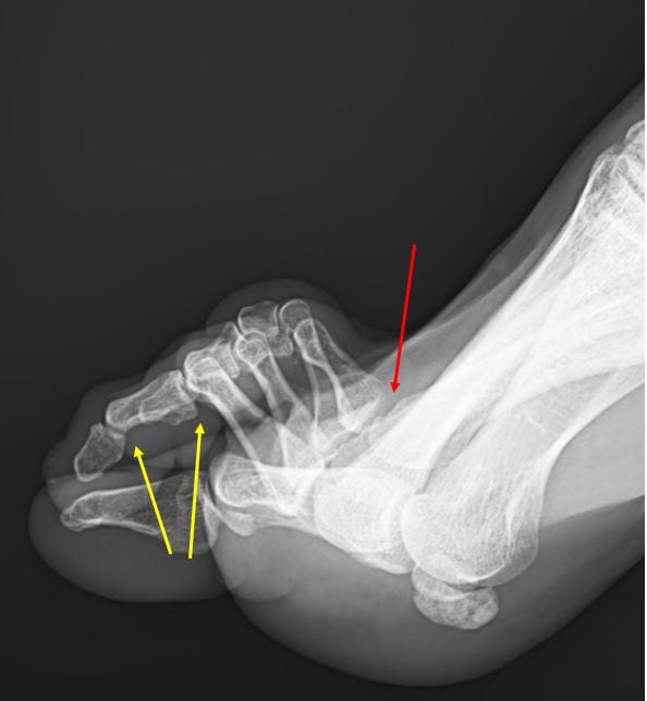X-ray of Claw Foot Resolution