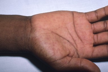 A 10-Year-Old with Fever, Headache, Muscle Aches, Nausea—and a Suspicious Rash