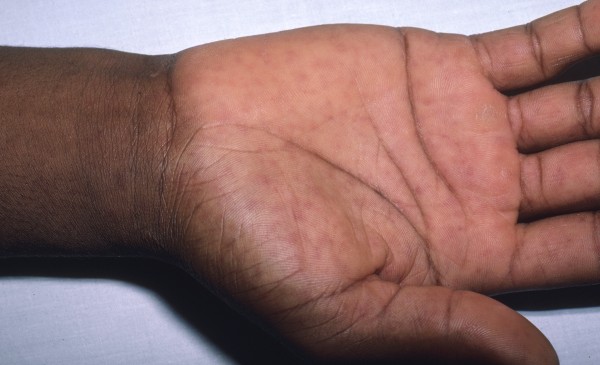 Suspicious Rash, Rocky Mountain spotted fever Image