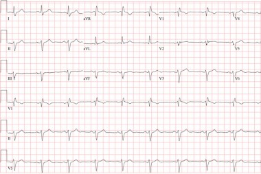 A 58-Year-Old Male with Chest Pain
