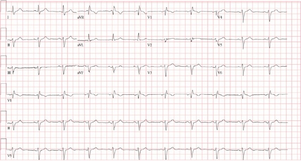 ECG 1 - bifascicular block