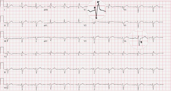 ECG Resolution - bifascicular block