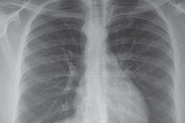 A 35-Year-Old with a Persistent, Frequent Cough