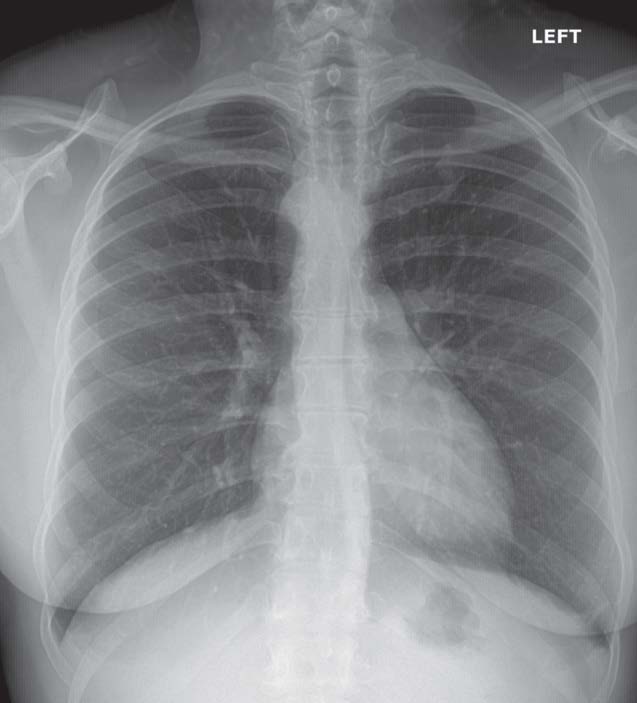 persistent, frequent cough x-ray