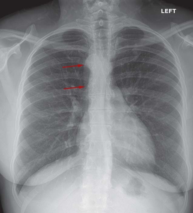 persistent, frequent cough x-ray resolution