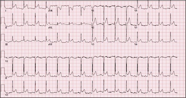 pleuritic chest pain patient ECG