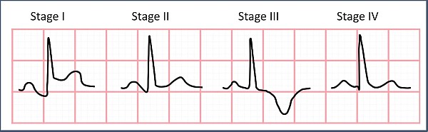 Morphologic features of the various stages of pericarditis., sharp, pleuritic chest pain