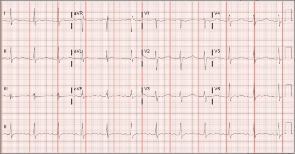 31-year-old Male Complaining of Weakness ECG