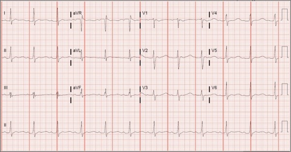 31-year-old Male Complaining of Weakness ECG