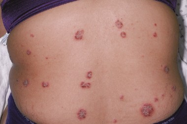 A 55-Year-Old with a Recent History of Rash