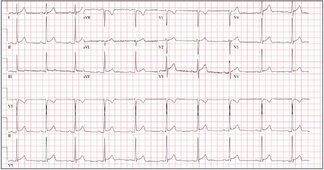 Early Repolarization 