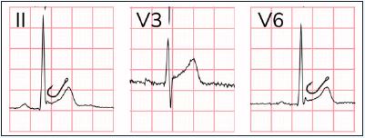 Fishhook appearance of Early Repolarization 