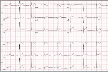 39-year-old Male with Sharp, Nonradiating Chest Pain