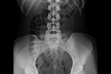 An 18-Year-Old with Diffuse Abdominal Pain